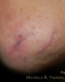 Skin Surgery Before & After Photos